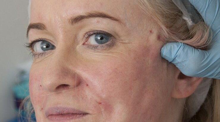 Νέου τύπου λίφτινγκ: Σφίγγουν το δέρμα με νήματα [εικόνες]