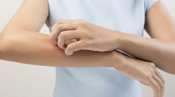 Πώς να αντιμετωπίσουμε τα μικρής έκτασης επιφανειακά εγκαύματα