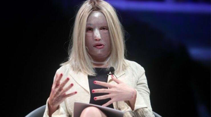 Ιωάννα Παλιοσπύρου: Δείτε την να γυμνάζεται για πρώτη φορά μετά την επίθεση με βιτριόλι [βίντεο]