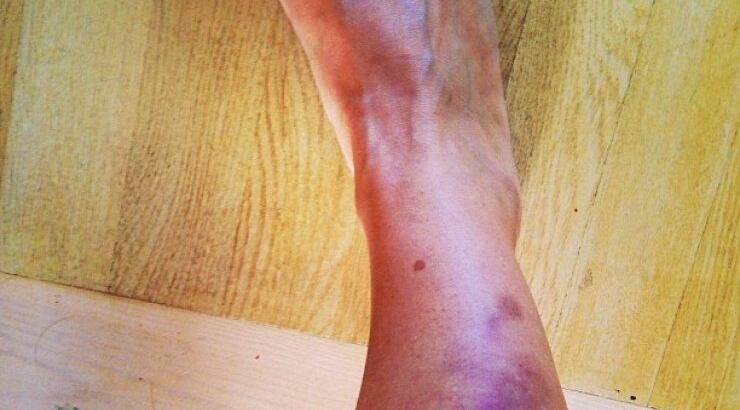 Με μελανιασμένο πόδι Ελληνίδα παρουσιάστρια