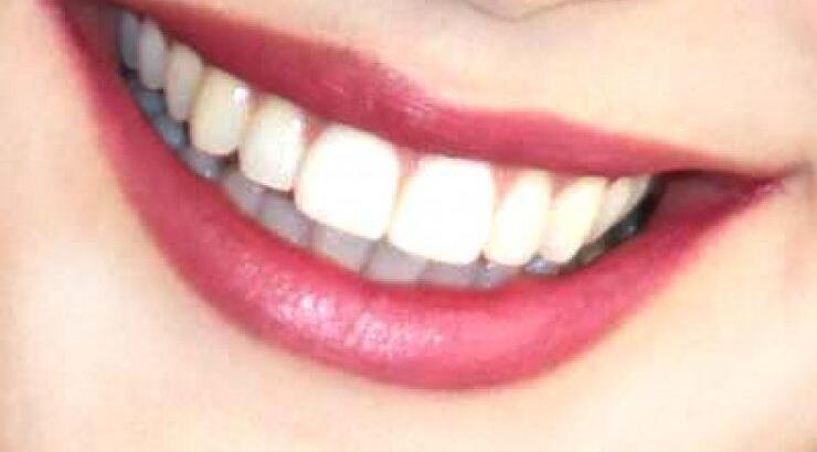 Τέλειο χαμόγελο