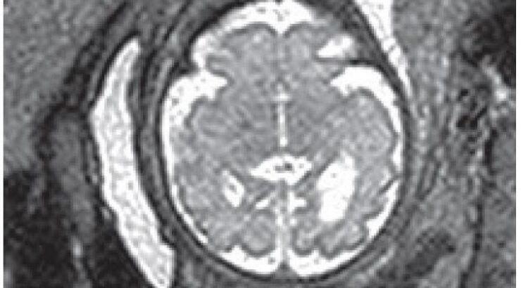Προγεννητική μαγνητική τομογραφία για τον εγκέφαλο [Βίντειο]