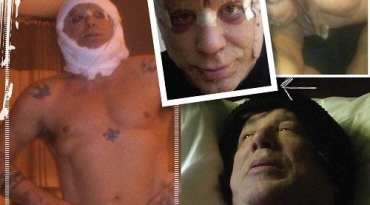 Mickey Rourke: Δείτε τις photos μετά την τελευταία πλαστική
