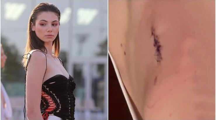 Συγκλονίζει η Μαριαγάπη Ξυπολιά: Μας δείχνει την πλάτη της - "Αφαίρεσα ένα ολόκληρο κομμάτι όγκου" [βίντεο]