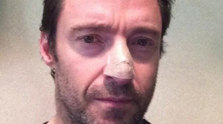 Με καρκίνο του δέρματος διαγνώστηκε ο Χιου Τζάκμαν 