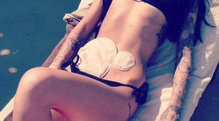 Η γυναίκα με τη νόσο του Crohn που τολμά και δείχνει το σώμα της