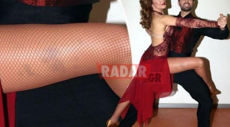 Ευγενία Μανωλίδου: Δείτε τις μελανιές στο πόδι της