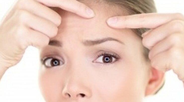 10 απλοί και φυσικοί τρόποι για να απαλλαγείς από την ακμή