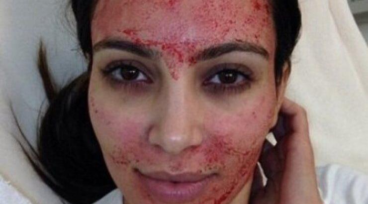 Κim Kardashian: Έκανε θεραπεία προσώπου με το ίδιο της το αίμα! 