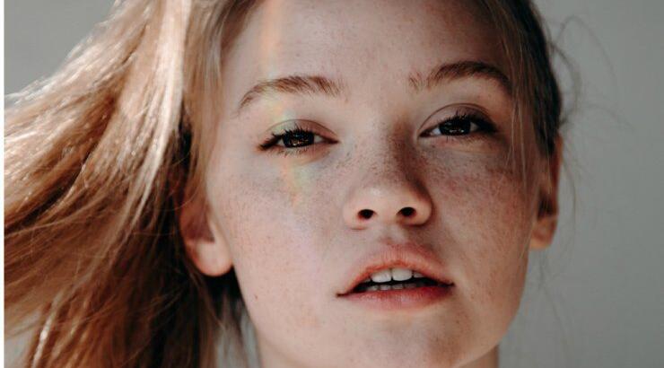 Τέσσερις λόγοι που προκαλούν καλοκαιρινή ακμή