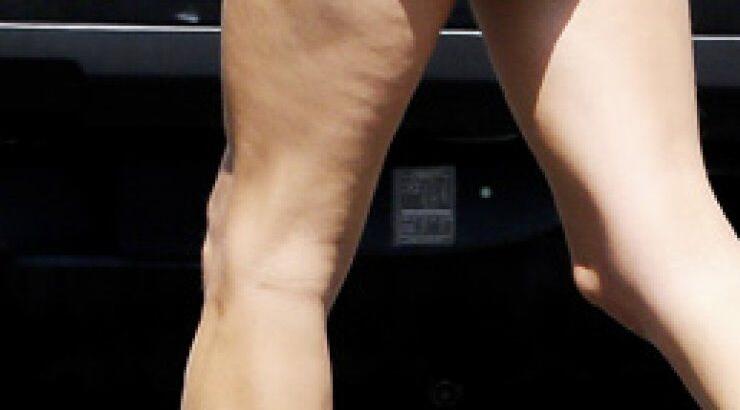 Ακόμη ένα μοντέλο με κυτταρίτιδα! Ποια είναι; [εικόνες]