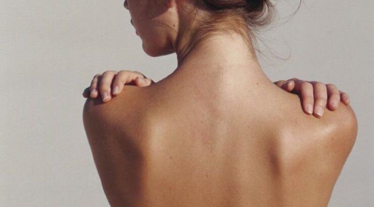 Ακμή στην πλάτη: Επίμονη και ενοχλητική 