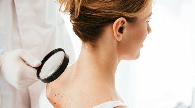 Μάιος: Ο μήνας αφιερωμένος στην πρόληψη του καρκίνου του δέρματος