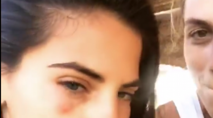 Με χτυπημένο μάτι η σύντροφος του Σάκη Τανιμανίδη στις διακοπές τους!