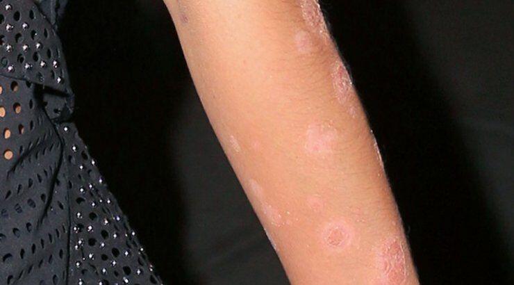 Πασίγνωστο μοντέλο έδειξε για πρώτη φορά τα σημάδια ψωρίασης στο σώμα της!