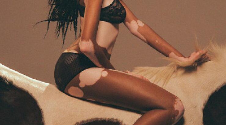 Chantelle Young: Το Next Top Model της Αμερικής έχει λεύκη