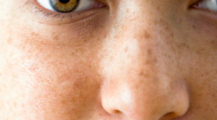 Πως να αντιμετωπίσεις τις πανάδες