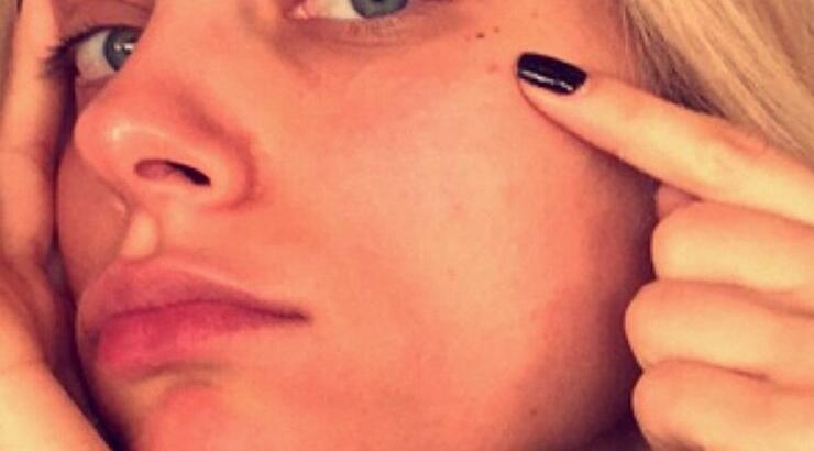 Η μαγική συνταγή για να αντιμετωπίσεις ένα ξαφνικό σπυράκι!