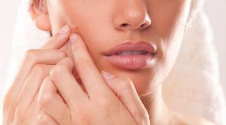 3 φυσικοί τρόποι για να εξαφανίσεις το σπυράκι σε χρόνο dt