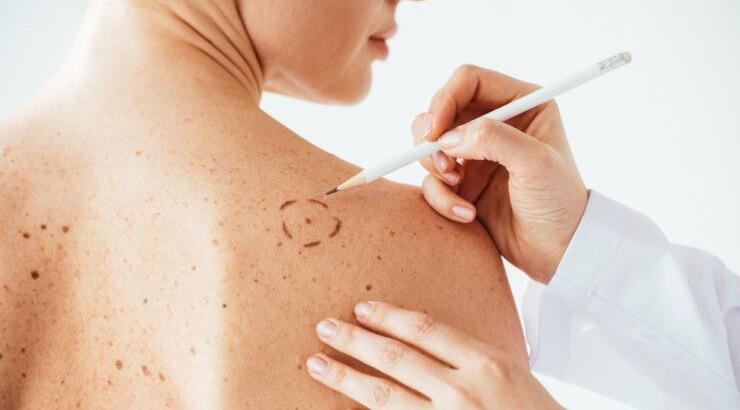 Ελιές στο σώμα: Οι αλλαγές που πρέπει να προσέξεις μετά το καλοκαίρι