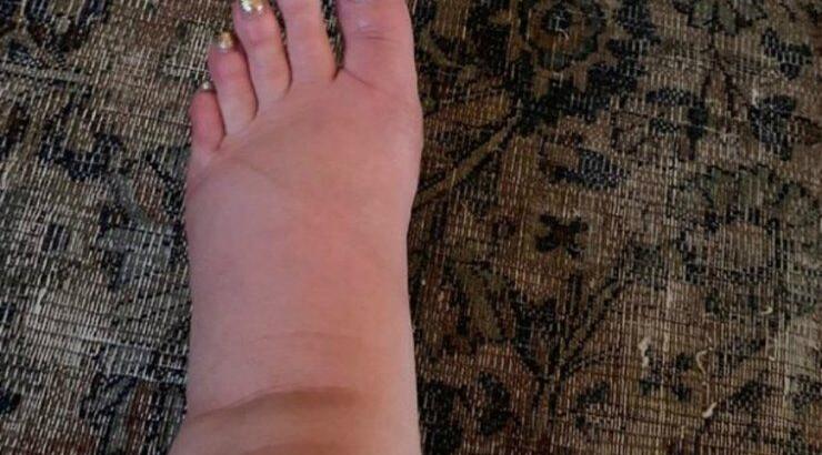 Διάσημη εγκυμονούσα ζητά συμβουλές για τα πρησμένα της πόδια