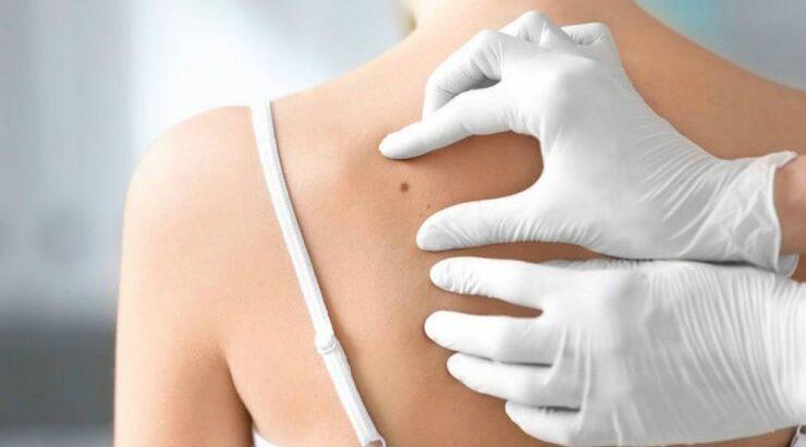 Καρκίνος του δέρματος: Τι πρέπει να προσέξουμε και πως να προφυλαχτούμε την καλοκαιρινή περίοδο