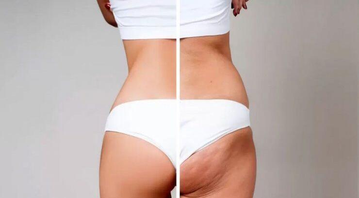 Εννέα τροφές που προκαλούν κυτταρίτιδα