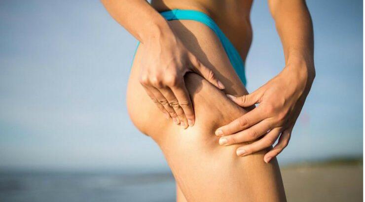 Κυτταρίτιδα: Όλα όσα πρέπει να γνωρίζετε και τι πρέπει να κάνετε για να την μειώσετε μέσω της διατροφής