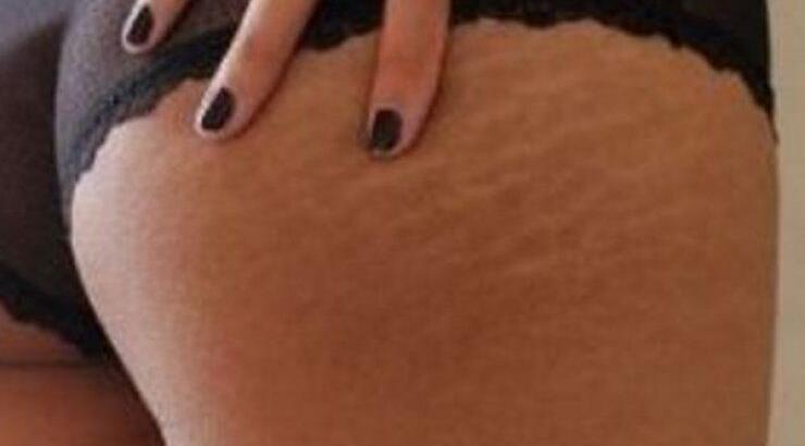 Εξάλειψη ραγάδων & κυτταρίτιδας για πάντα, εύκολα με μόνο 3 συστατικά!