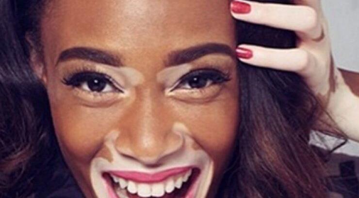 Η 19χρονη καλλονή με τη λεύκη που μεσουρανεί στις πασαρέλες [εικόνες]