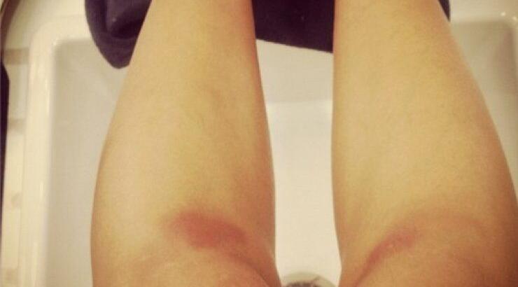 Ποια επώνυμη Κύπρια εμφανίστηκε με μελανιές στα πόδια…