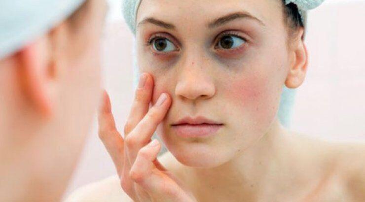 Μαύροι κύκλοι: Υπάρχει τρόπος να μάθετε εάν είναι εκ γενετής ή από την αϋπνία