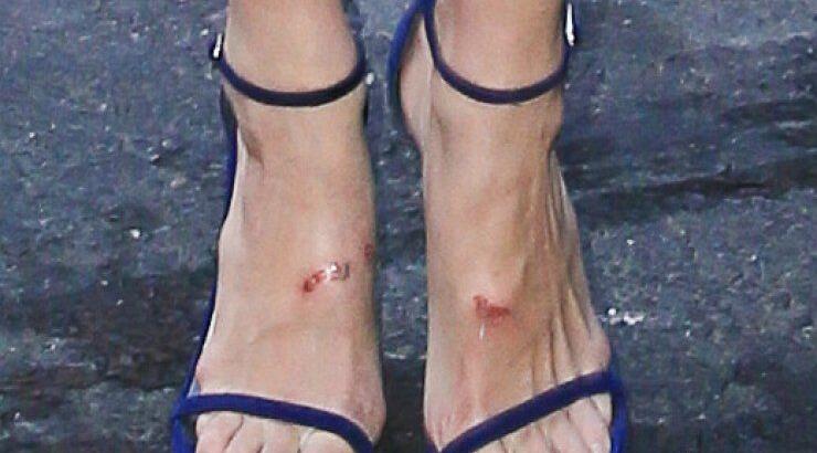 Ο τραυματισμός στα πόδια για πασίγνωστο μοντέλο!