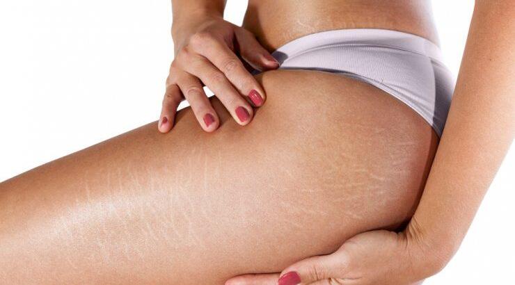 Ραγάδες: Συμβουλές για να τις αντιμετωπίσεις και 5 + 1 προϊόντα που θα σου χρειαστούν