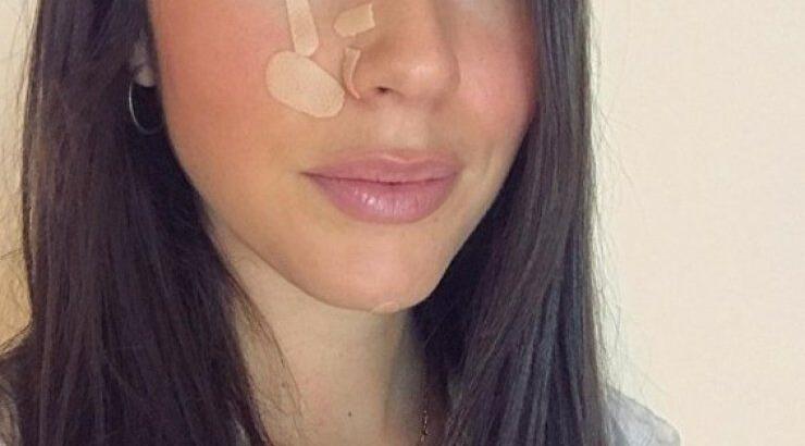 Ισμήνη Νταφοπούλου: Πώς είναι το πρόσωπό της τρεις μήνες μετά τον σοβαρό τραυματισμό