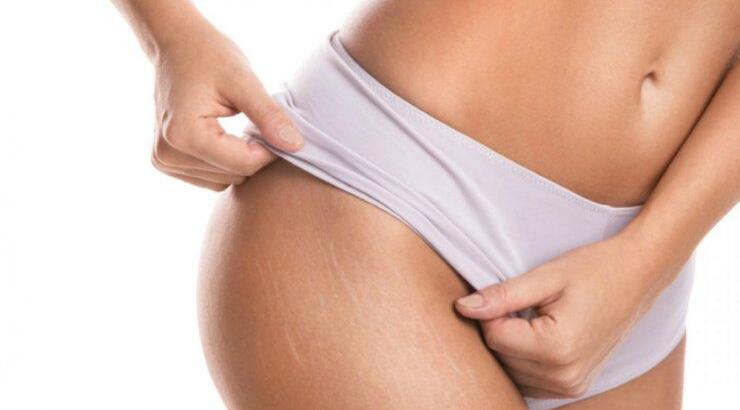 Ραγάδες: Υπάρχει θεραπεία και λέγεται "Skin Streak Lift"