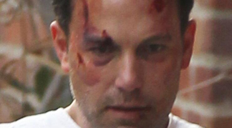Σοβαρά τραυματισμένος ο Ben Affleck [εικόνες]