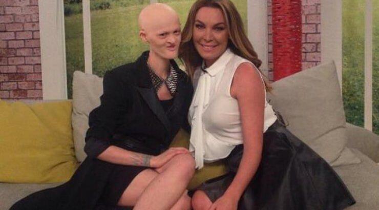 Το μοντέλο που πάσχει από βαμπιρισμό στην Τατιάνα: "Δεν έχω μαλλιά και δόντια λόγω της ασθένειάς μου"