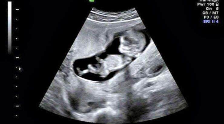 Ελληνίδα ηθοποιός ανακοίνωσε την εγκυμοσύνη της αναρτώντας τον υπέρηχο στο facebook!